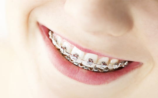 Conheça 5 dicas para o seu aparelho ortodontico funcionar melhor